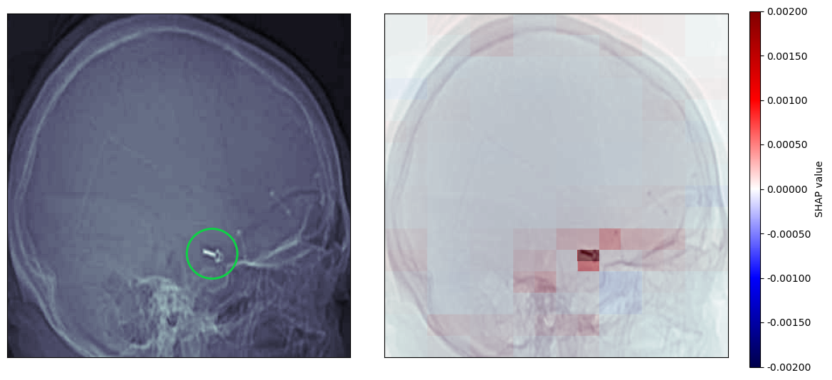 CT localiser image with a aneurysm clip
highlighted