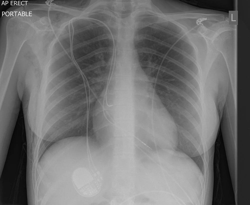 Chest X-ray with a cardiac
device