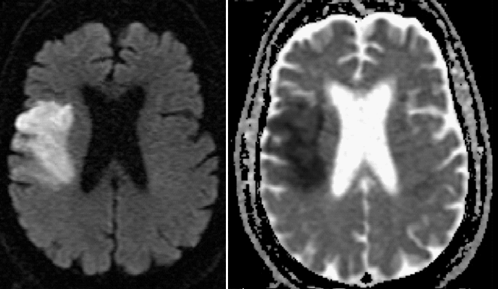 An MRI showing an acute stroke